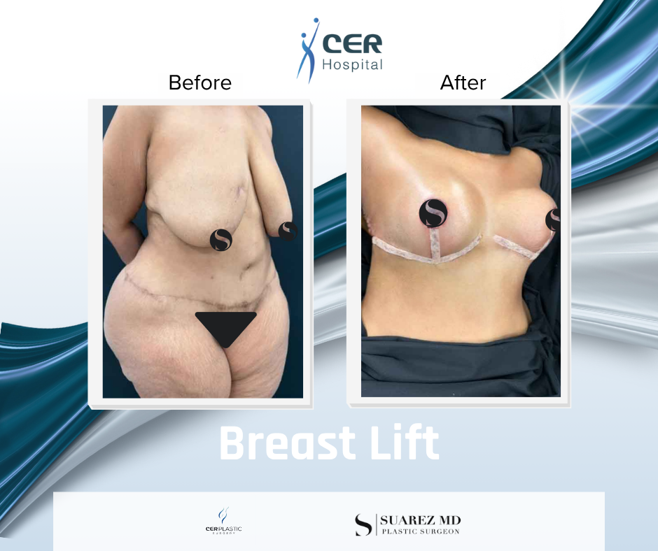 Breast Lift - 090626 - Image 2