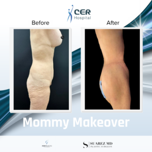 mommy makeover – 110626