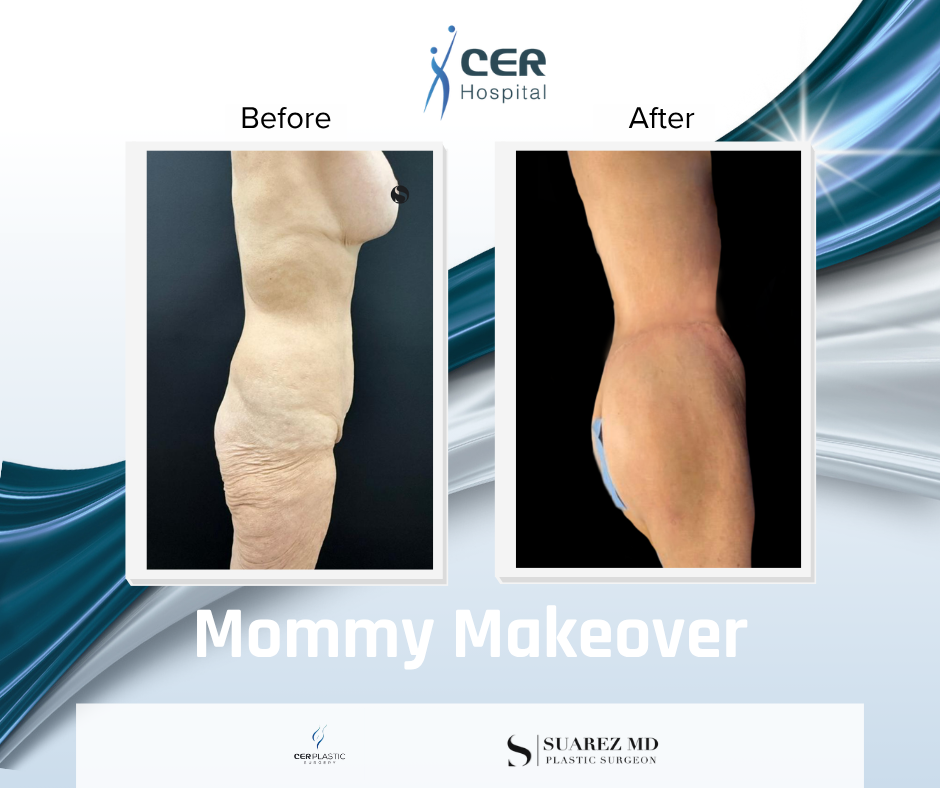 mommy makeover - 110626 - Image 2