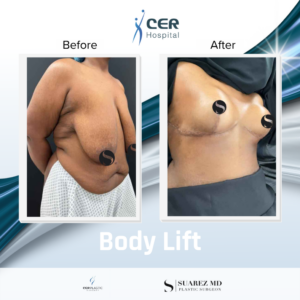 Body Lift – 040626