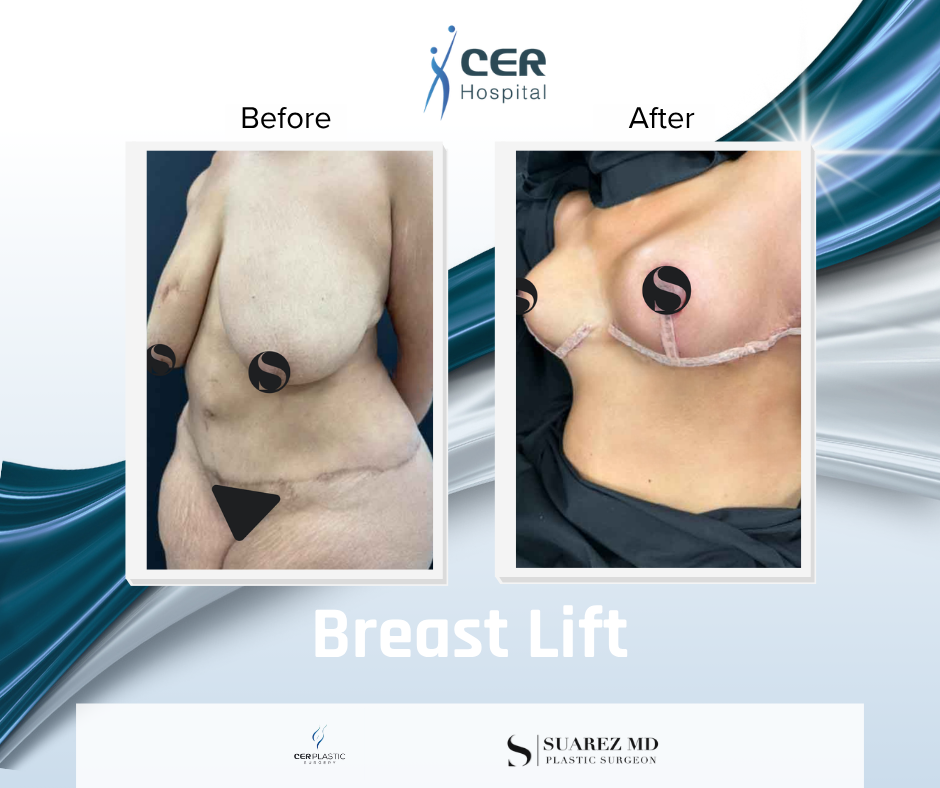 Breast Lift - 090626 - Image 3