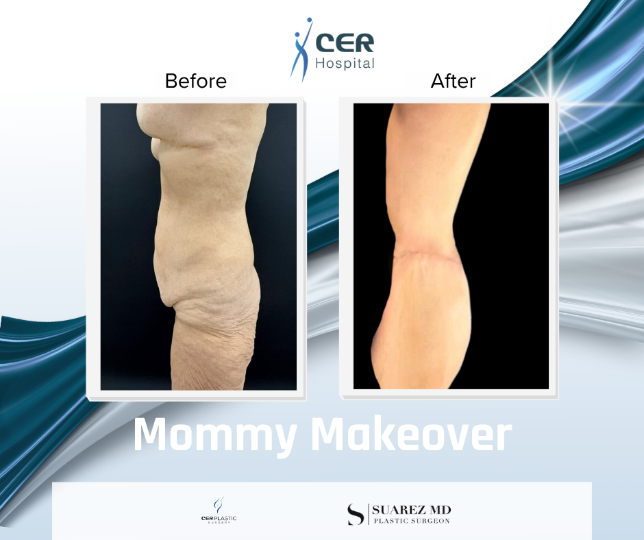 mommy makeover - 110626 - Image 3