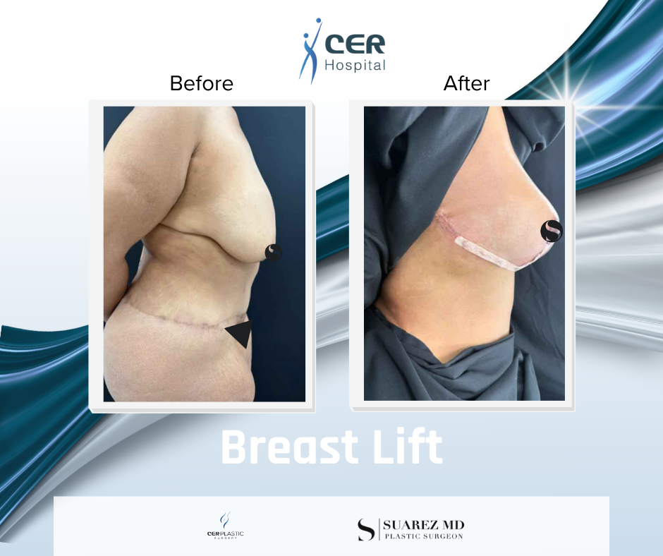 Breast Lift - 090626 - Image 4