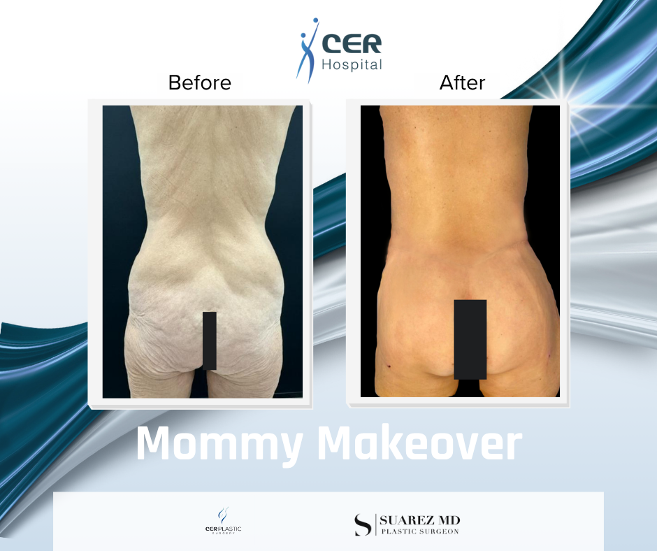 mommy makeover - 110626 - Image 4