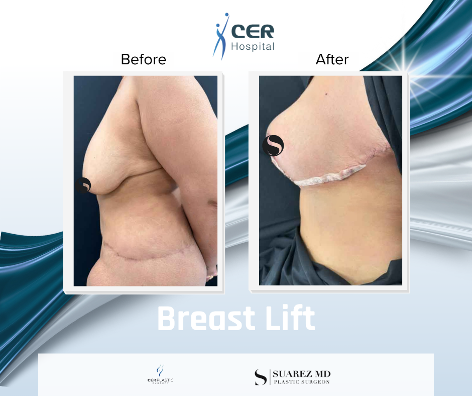 Breast Lift - 090626 - Image 5